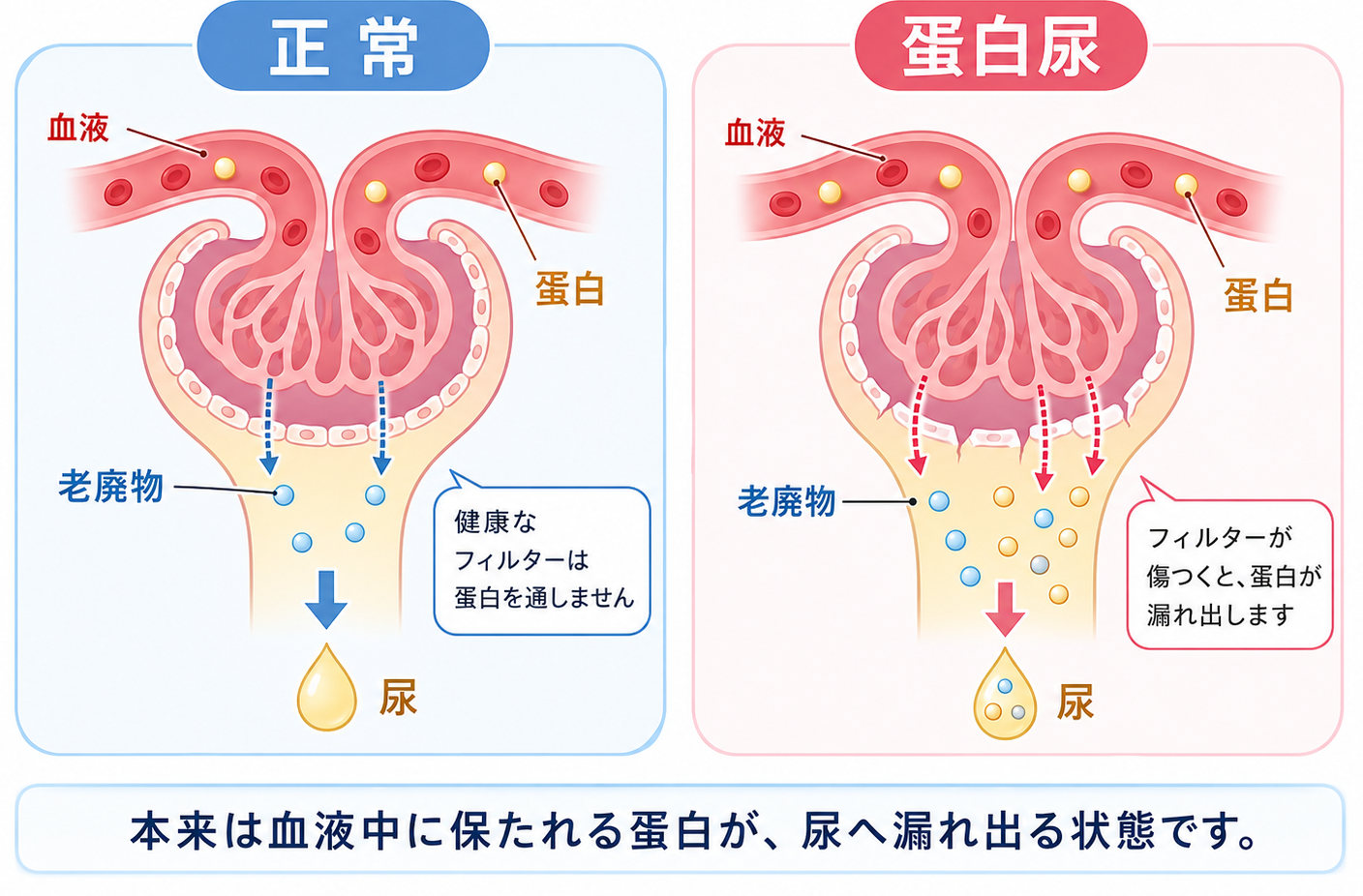 正常な状態とたんぱく尿の状態を比較し、糸球体のフィルター障害でたんぱく質が尿へ漏れ出ることを示す図